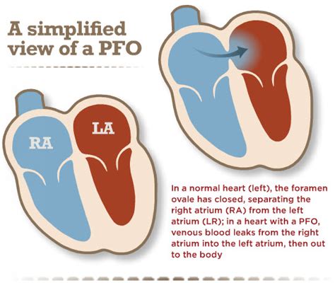 patent foramen ovale (pfo)